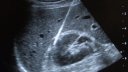 Emprint Needle visibility on ultrasound